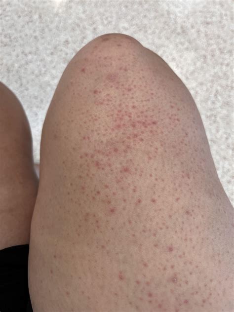 Razor Bumps On Legs Ingrown Hair: What Is It, Treatment, Prevention,