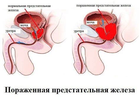 Обострение хронического простатита: причины, симптомы и лечение