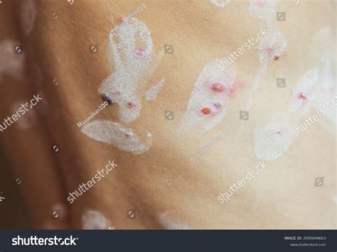 Chicken Pox Rash Chickenpox Disease Closeupconsequences Stock Photo ...