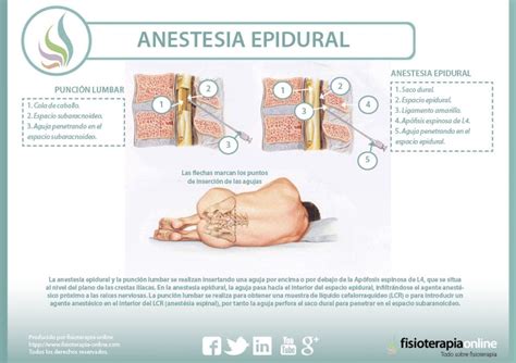 ANESTESIA RAQUIDEA PDF