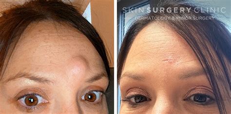 Sebaceous Cyst Removal Scar