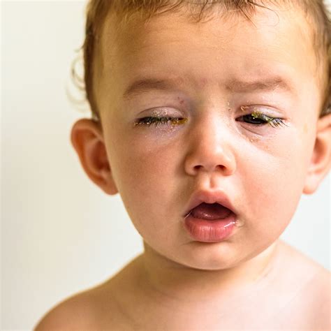 Eye Swelling Toddler at Jill Baker blog