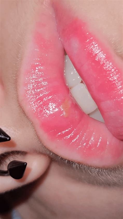 is this a canker sore? : r/CankerSores
