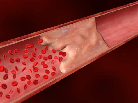 What is Calcified Plaque? - RAI