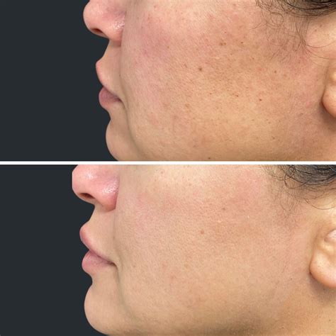 BBL Laser Brisbane | BBL Treatment - BBL Forever Young & BBL Facial