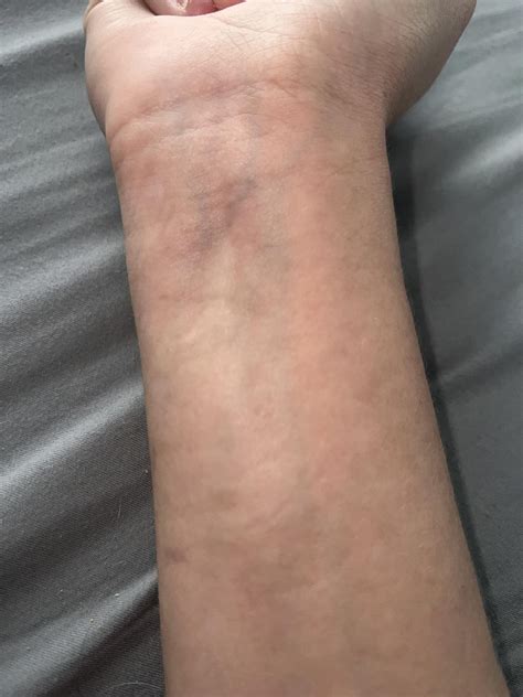 Why does my wrist look like this when I close my palm and flex? : r/medical