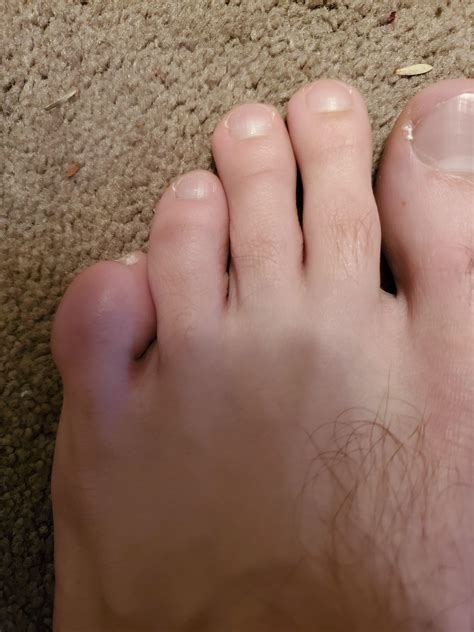 Swollen Pinky Toe How To Stop Shoes Rubbing On Your Little Toe