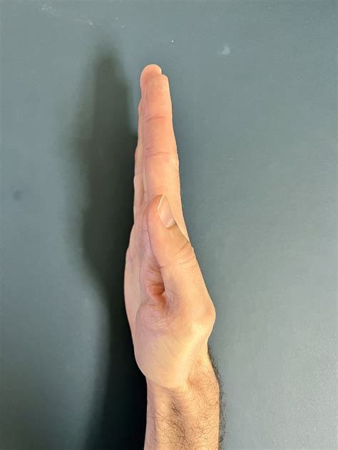 What Is Thumb CMC Arthritis? The Ultimate Guide For Patients — Dr. Nick ...