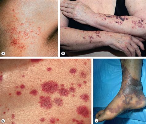 purpura mechanisms  differential diagnosis clinical tree
