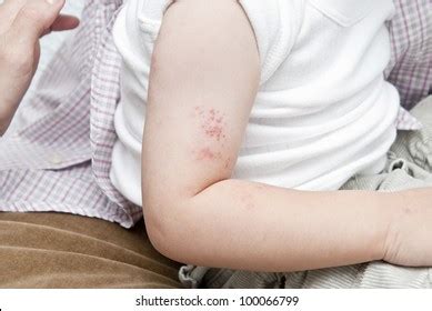 440 Shingles Herpes Zoster Pain Images, Stock Photos & Vectors ...