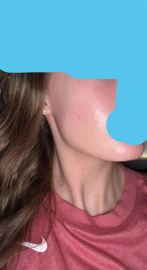 how to get rid of fungal acne 3