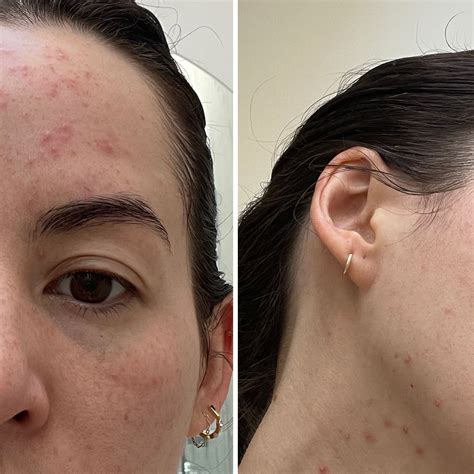 What Is Steroid Acne? Skin Tips From a Dermatologist | POPSUGAR Beauty