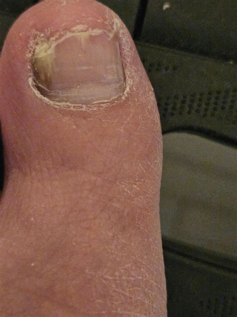 Subungal melanoma? : r/Melanoma
