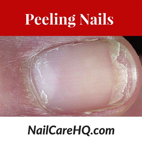 Peeling Nails - Pure Nail Oil™ Challenger Marie Claire's Results