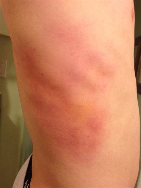 how to pronounce bruising