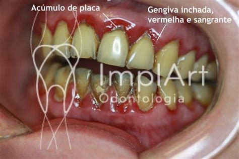 Infecção Na Gengiva Como Tratar