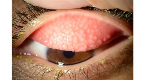 Giant Papillary Conjunctivitis Treatment