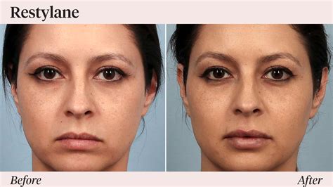 Restylane Under Eyes Before And After