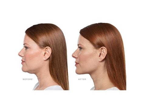 KYBELLA®