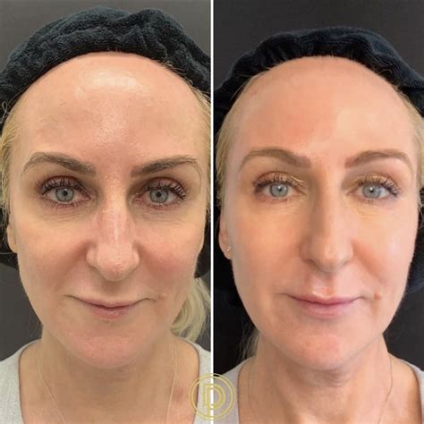 ways sculptra rebuilds brightens  elevates  skin naturally