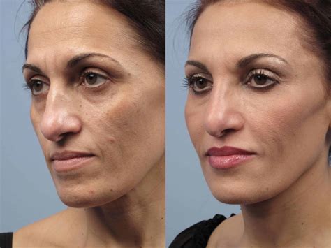 Fractional CO2 Laser | Toronto Plastic Surgeons