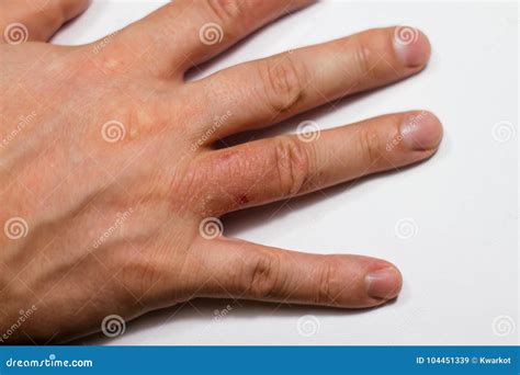 Hand Dermatitis. Hand Eczema Royalty-Free Stock Photo | CartoonDealer ...