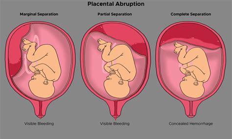 Abdominal Separation During Pregnancy Symptoms at Edward Oneal blog