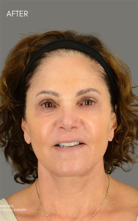 gallery brow lift advanced facial surgery