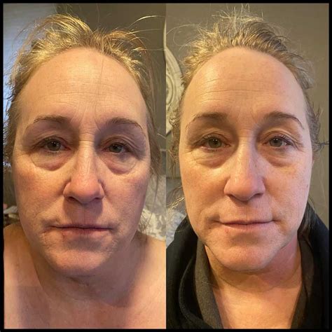 CryoSlimming, CryoToning, and CryoFacial Results | NorCal CryoSlim