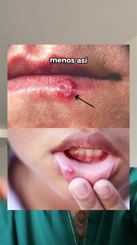 Enfermedades En Los Labios Manifestaciones Bucales De La Enfermedad
