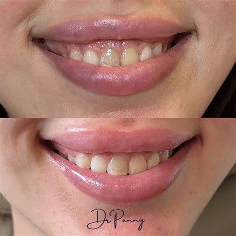gummy smile voor en na dr penny