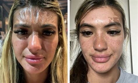 treat peeling skin  face  sunburn  william foxworth blog