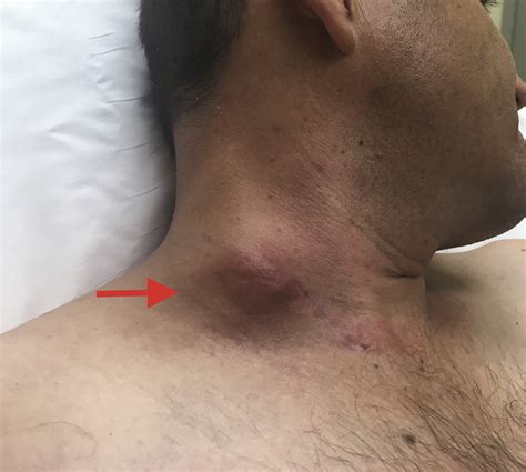 cervical tuberculous lymphadenitis journal  emergency medicine