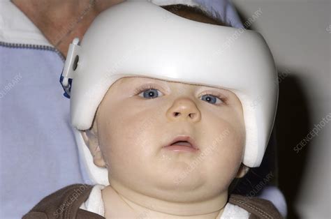 Helmet to treat plagiocephaly - Stock Image - M350/0319 - Science Photo ...