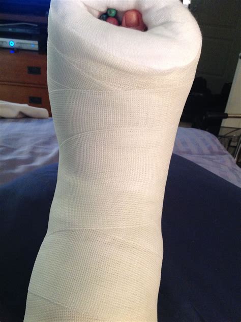 First "soft" cast.... getting second one in 3 days! | It cast, Just