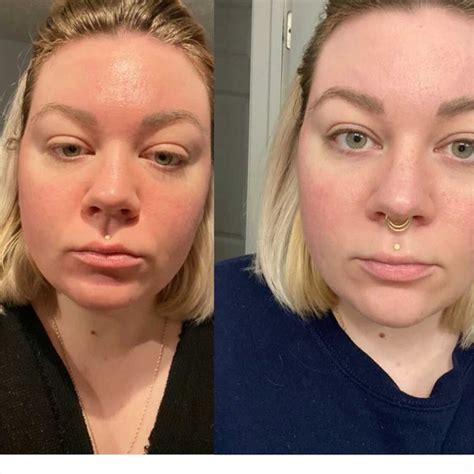 Clear Skin Guide for Rosacea & Sensitiveskin, Living With Rosacea ...