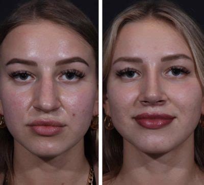 bulbous tip rhinoplasty nyc wide nasal tip  york city