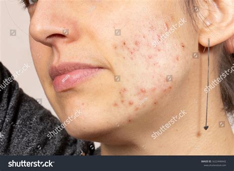 left side closeup woman face acne stock photo  shutterstock