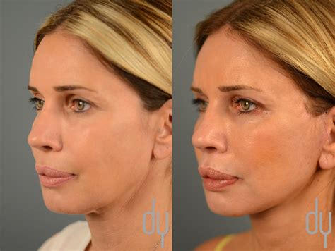 Facelift Before and After | Deep Plane Facelift Recovery | Beverly ...