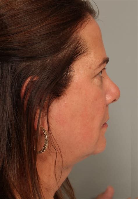 Neck Liposuction 8770