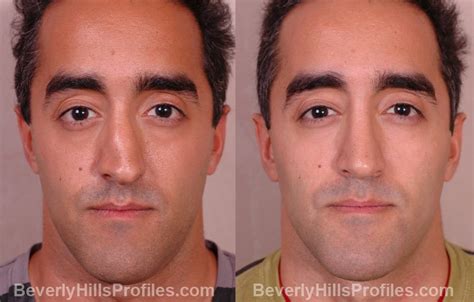 Nose Surgery Before And After Male : Male Rhinoplasty Patient 12 ...