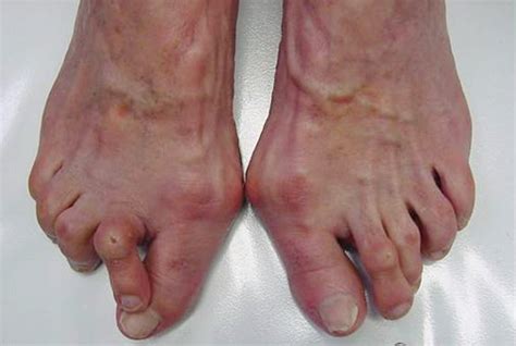 hallux varus   treatment healthbeauty  health