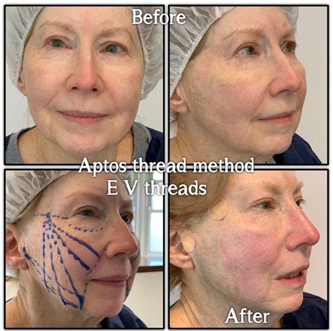thread lifts minimally invasive cosmetic procedure