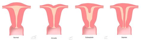 MYTH: You can’t carry to term with an arcuate uterus | National ...