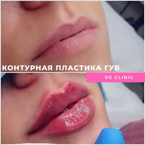 Контурная пластика губ — VG CLINIC