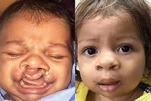 Cleft Lip Surgery | Cleft Palate Surgery | Dr. Andrew Jacono