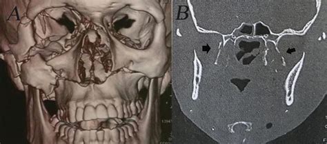 Maxillofacial Fractures: From Diagnosis to Treatment | IntechOpen