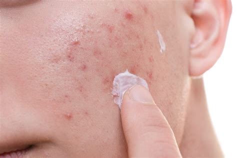 topical antibiotics  treating acne