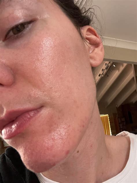 Does anybody else’s fungal acne look like this? I have no idea what’s