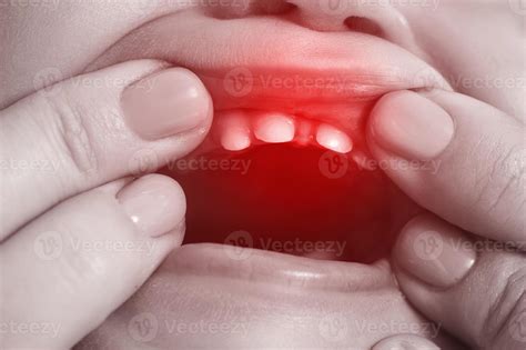 Baby suffering from painful teething symptoms 14394843 Stock Photo at